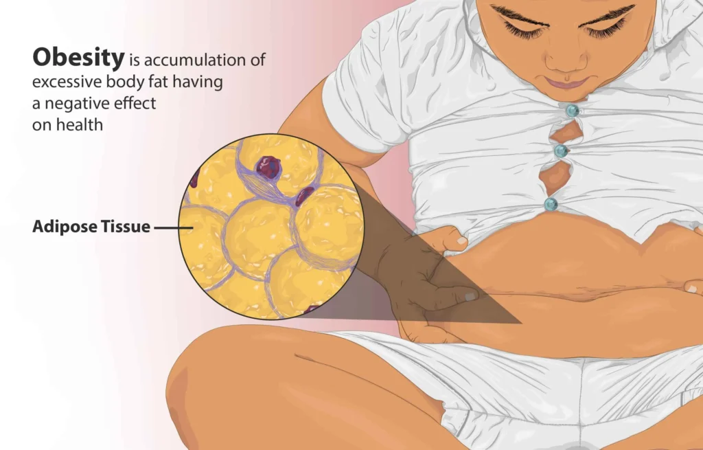 Depiction of a child with belly fat.